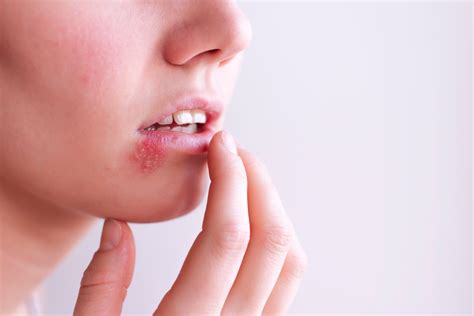 tongue herpes infection examples